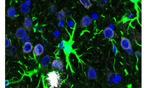 Alzheimer: alterazioni molecolari negli astrociti condizionano il cervello